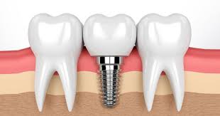 Corticobasal Implants