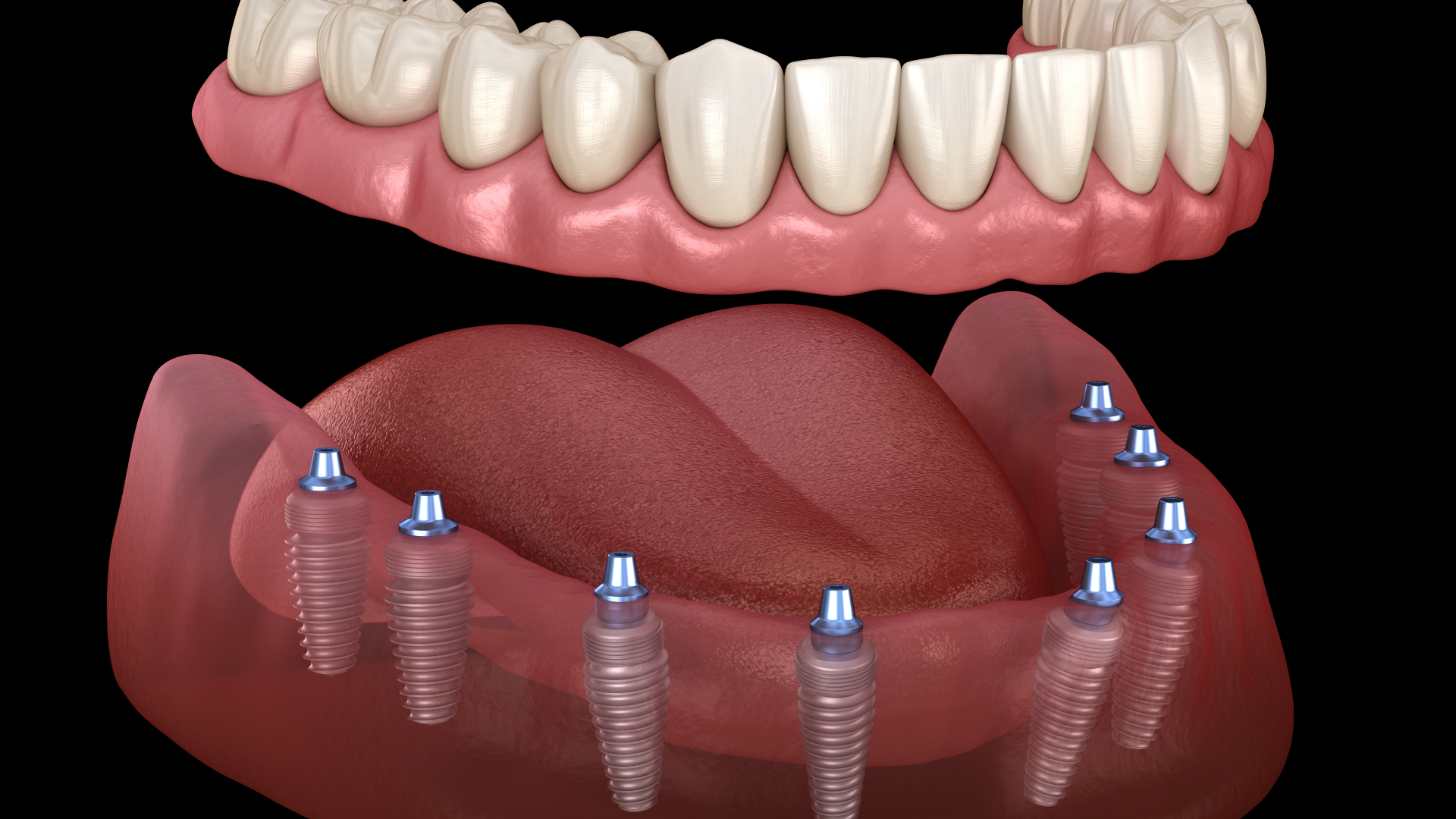 Fixed Implant Prosthesis