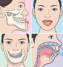 Lower Jaw Correction