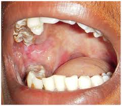 Oral Submucous Fibrosis