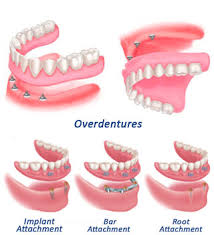 Over Dentures
