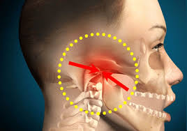 Temporomandibular Joint Ankylosis