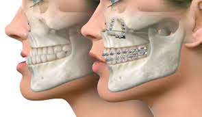 Upper Jaw Correction