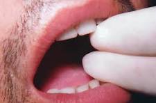 Reduced Mouth Opening